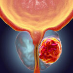 Le cancer de la prostate
